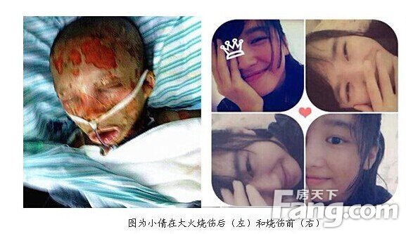 义乌20岁女大学生吃烧烤 被酒精喷全身起火