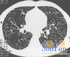 矽肺病人的ct扫描图片.在正常人的图片中应当看不到那么粗的肺纹理